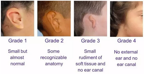 先天性小耳畸形(microtia),或称为先天性外中耳畸形,表现为重度耳廓